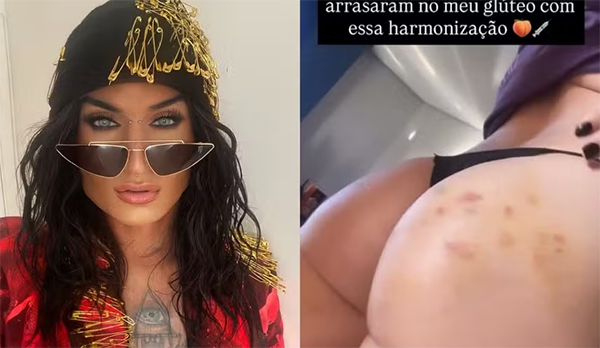 Harmonização glútea e contorno corporal: a técnica usada por ex-BBB Serginho