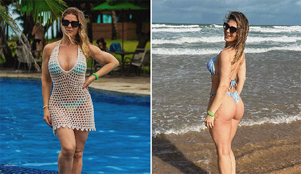 Sheila Mello faz tratamento com colágeno no bumbum: entenda em que casos a técnica realmente funciona