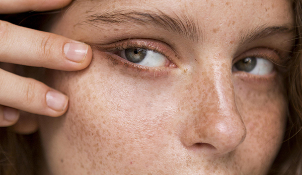 Manchas: novas estratégias incluem laser frio, oxigenação celular e hidrodermoabrasão